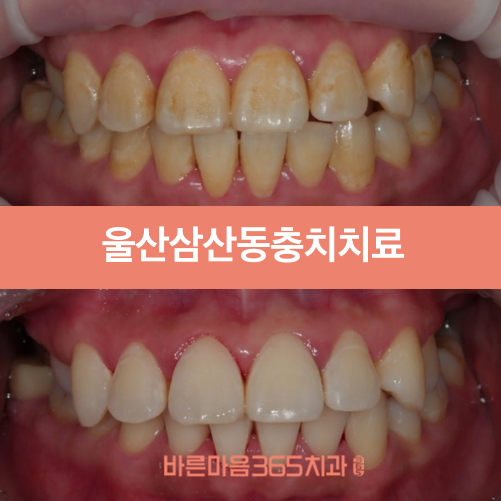 울산삼산동충치치료