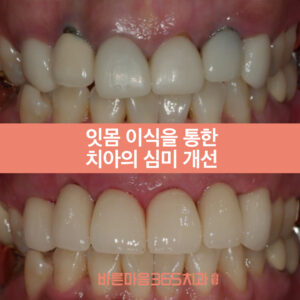 울산삼산동심미보철