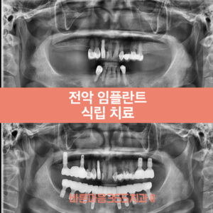울산삼산동임플란트