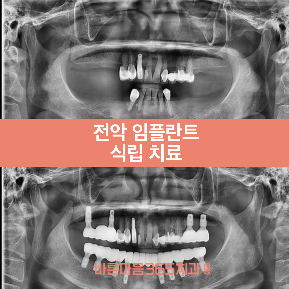울산삼산동임플란트