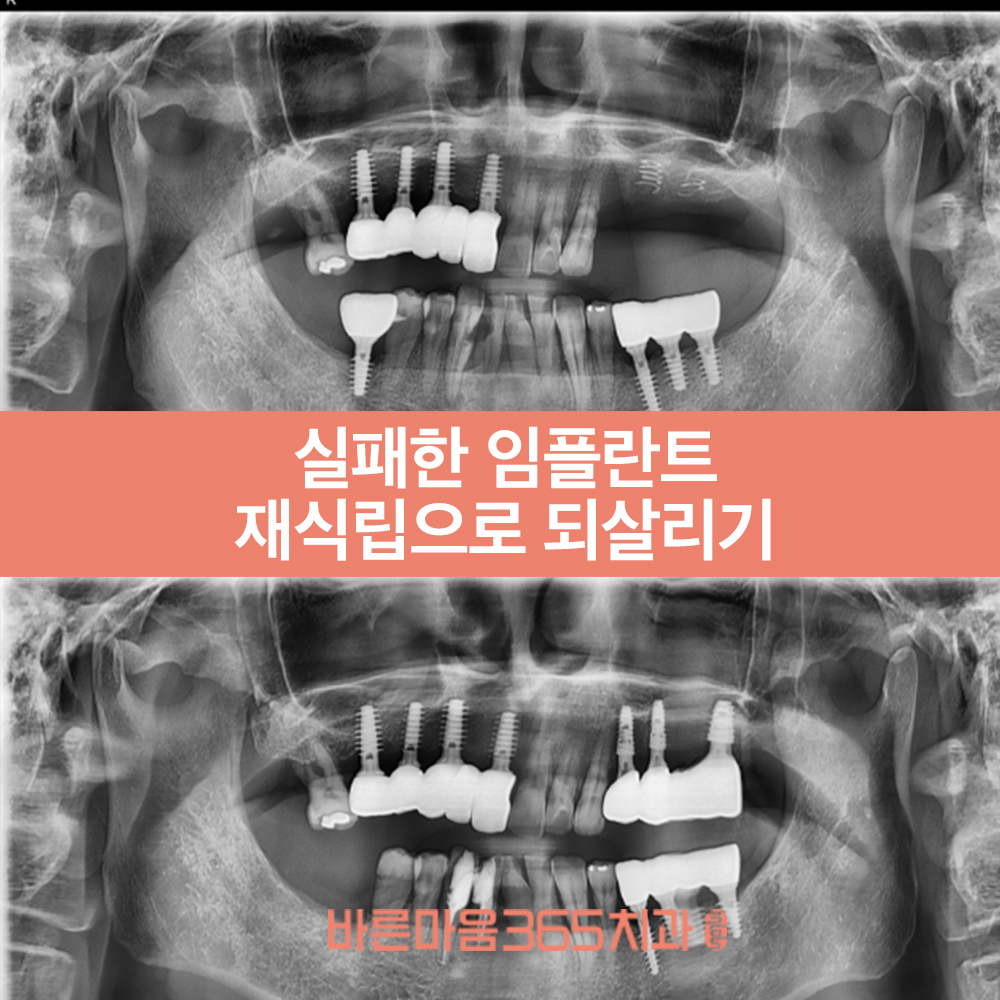 울산삼산동임플란트