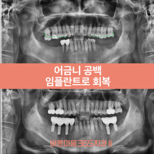 울산삼산동임플란트