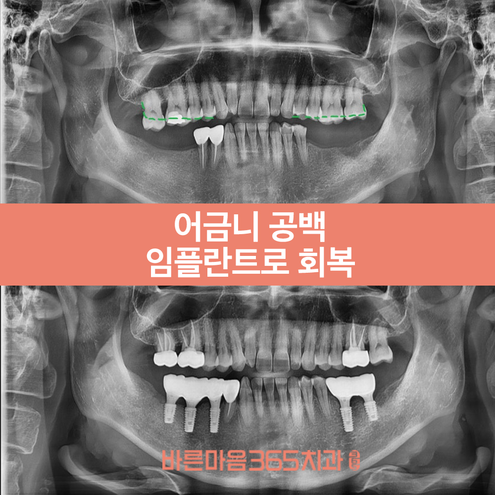 울산삼산동임플란트