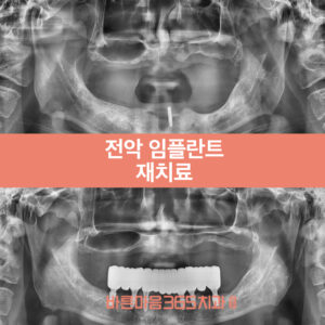 울산삼산동임플란트