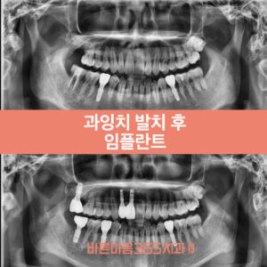 울산삼산동임플란트