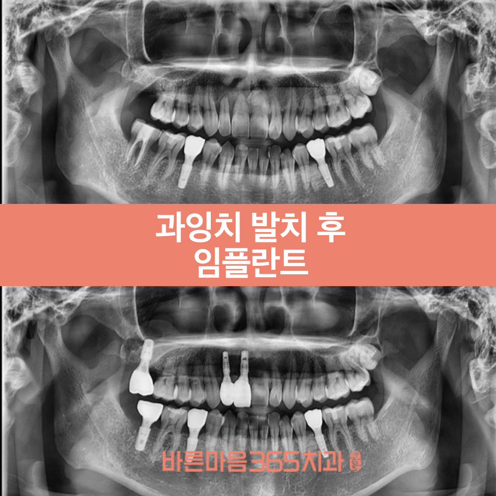 울산삼산동임플란트