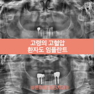 울산삼산동임플란트