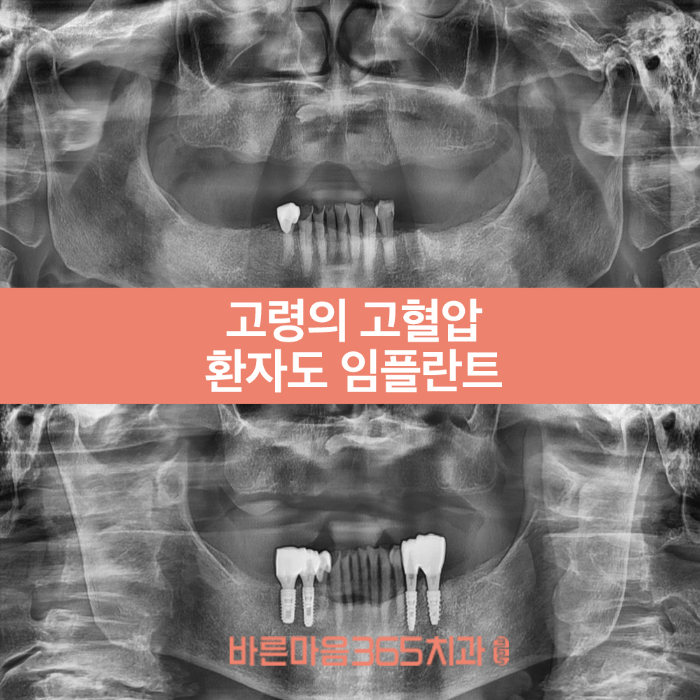 울산삼산동임플란트