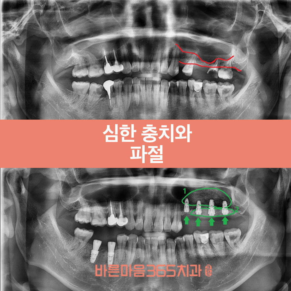 울산삼산동임플란트