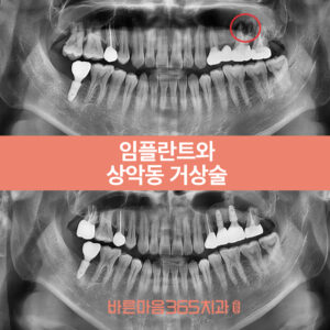 울산삼산동임플란트