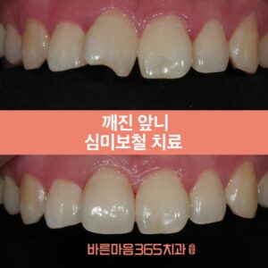 바른마음365치과_울산삼산동치과_ 블홈썸네일